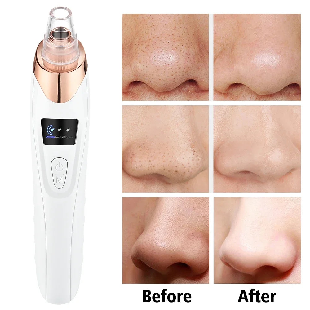 Lumi Theory Blackhead Remover