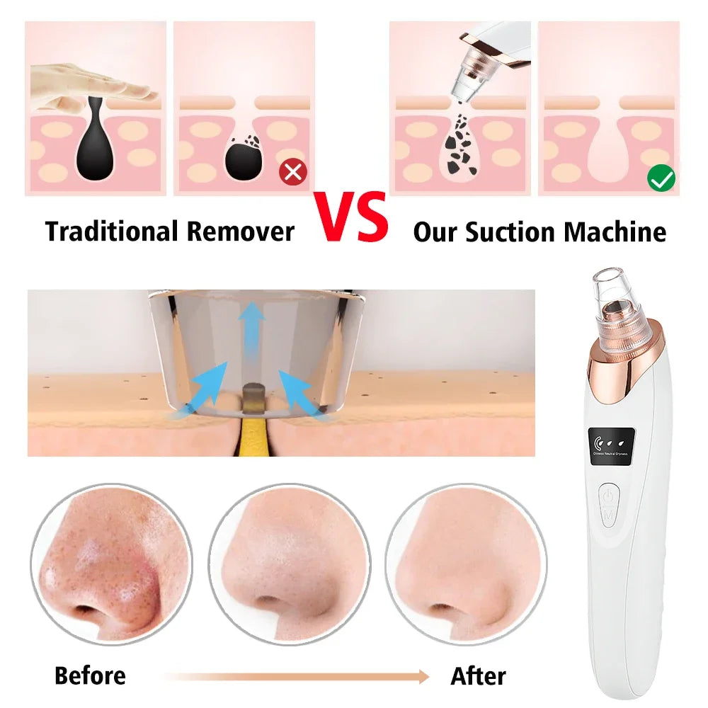 Lumi Theory Blackhead Remover